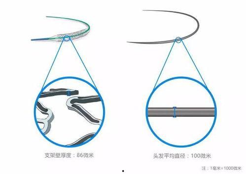 国产火鹰支架视频,创新引领心血管介入治疗新篇章